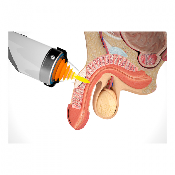 Модульный аппарат для ударно-волновой терапии Duolith SD1 ultra-3